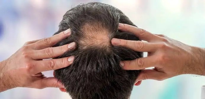 what-causes-bald-spots-on-head-design-talk